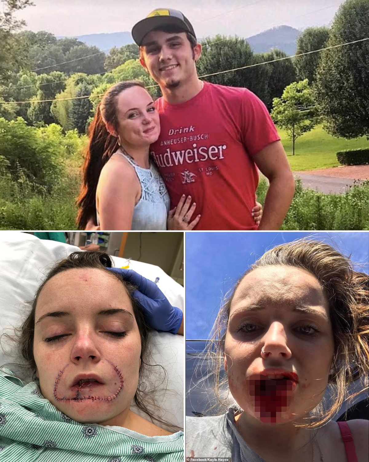 Woman whose entire lip was bitten off by her violent ex boyfriend reveals what she looks like seven years after brutal attack